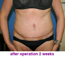 plastic-surgery-tummy-tuck